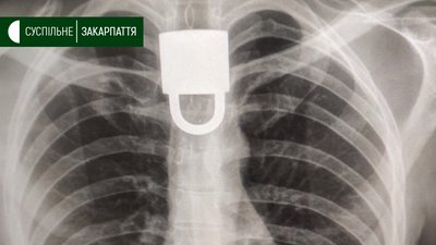 У Виноградівській районній лікарні виймали з пацієнта колодку У Виноградівській районній лікарні виймали з пацієнта колодку