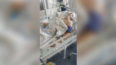 "Важкий, але стабільний": стан 13-річного Андрія, якого збила п'яна водійка