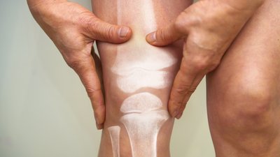У Миколаєві відновлюють програму безкоштовної заміни суглобів