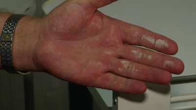 У відділенні нефрології та діалізу миколаївської лікарні коридори та палати наповнилися пилом У відділенні нефрології та діалізу миколаївської лікарні коридори та палати наповнилися пилом