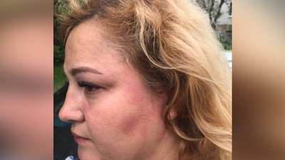 У Житомирі поліція перевіряє інформацію про побиття волонтерки лікарем