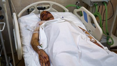 У лікарнях Дніпра залишаються 18 травмованих через ракетний удар по багатоповерхівці