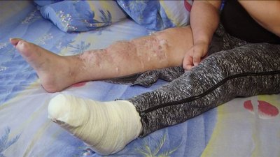 У Вінниці збирають гроші на операцію учаснику АТО
