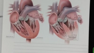 В першій лікарні Житомира почали проводити операції із відновлення кровоплину у судинах серця В першій лікарні Житомира почали проводити операції із відновлення кровоплину у судинах серця