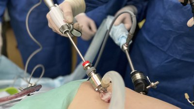 Львівські хірурги видалили лучанці пухлину наднирника діаметром понад 10 см