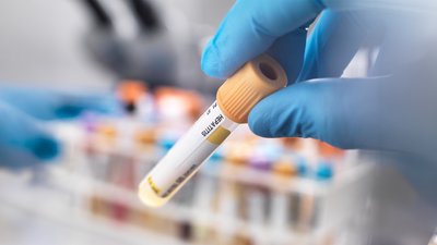 Протягом пів року на Чернігівщині захворіли на вірусні гепатити близько 160 людей