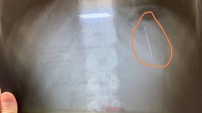 У Дніпрі тринадцятирічний хлопчик проковтнув голку