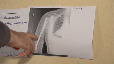Після боїв та поранення: як проходить реабілітацію військовий у Черкасах Після боїв та поранення: як проходить реабілітацію військовий у Черкасах