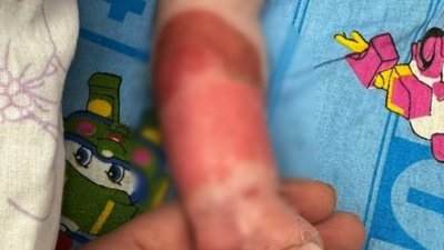 Дитина з епідермальним некролізом