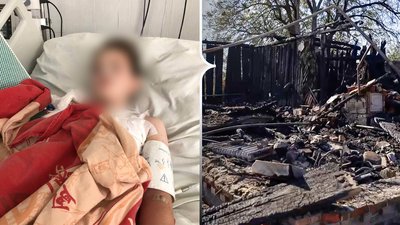 На Чернігівщині дядько витягував з-під завалів племінника, який зазнав понад 40% опіків