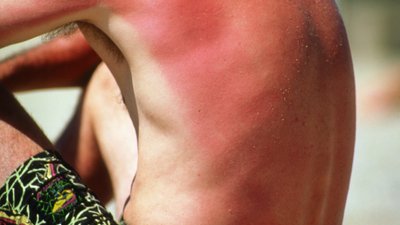 Що робити, якщо згоріли на сонці? Поради від біологині Дар’ї Озерної Що робити, якщо згоріли на сонці? Поради від біологині Дар’ї Озерної