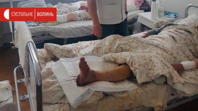 "Не може повірити, що нога на місці". Луцькі лікарі вперше пришили кінцівку