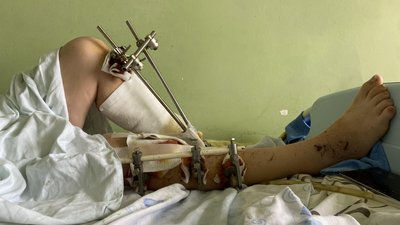 Пересадили м'яз зі спини на ногу: у Львові жінці з Бахмута врятували кінцівку від ампутації Пересадили м'яз зі спини на ногу: у Львові жінці з Бахмута врятували кінцівку від ампутації