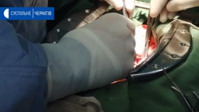 У Чернігові вперше зробили комбіновану операцію на серці й легенях У Чернігові вперше зробили комбіновану операцію на серці й легенях