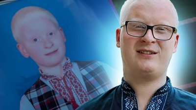 "Мене обзивали дідом": історія кропивничанина із альбінізмом Олександра Гузя