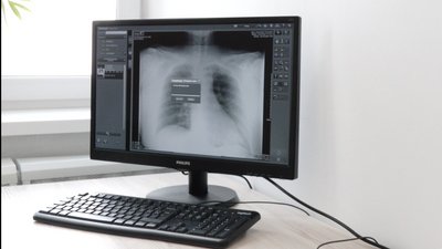Два рентгенапарати закуплять для черкаських лікарень