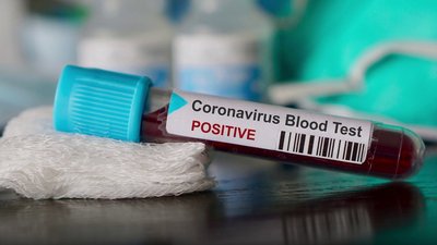 За добу на Чернігівщині коронавірус виявили у 401 людини