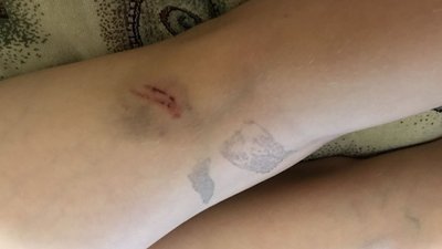 Безпритульний собака покусав учня біля школи на Рівненщині Безпритульний собака покусав учня біля школи на Рівненщині