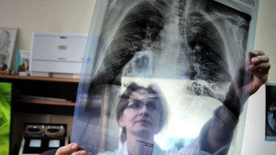 "Про мене усім розповіла медсестра". Як пацієнтка з туберкульозом пережила і хворобу і булінг "Про мене усім розповіла медсестра". Як пацієнтка з туберкульозом пережила і хворобу і булінг