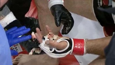 Втрачений палець Втрачений палець
