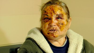 "Все — в лице. Слава Богу, що ми бачимо": жінка, яка вижила у Покровську 6 січня, розказала про ракетну атаку