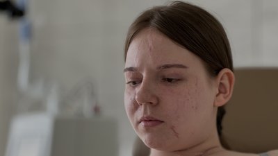 Львівські медики відновлюють обличчя 20-річній дівчині з Луганщини