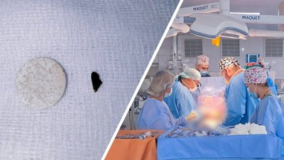 На Вінниччині медики видалили металевий уламок із працюючого серця пацієнта