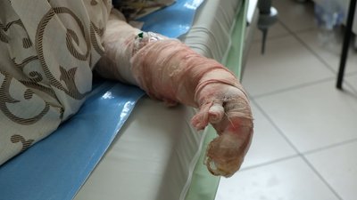 "Три пацієнти померли у реанімації": що відомо про постраждалих внаслідок ракетного обстрілу Вінниці "Три пацієнти померли у реанімації": що відомо про постраждалих внаслідок ракетного обстрілу Вінниці