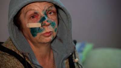 "Вдруге снаряд наздогнав. "Спасибі" Путіну, щоб він здох". В якому стані поранені після обстрілу Гірника
