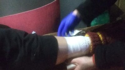 У Карпатах турист травмував ногу. Допомагали рятувальники У Карпатах турист травмував ногу. Допомагали рятувальники