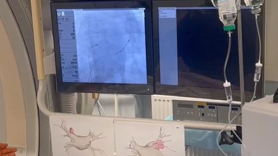 Рятівний холод: у черкаському кардіоцентрі почали робити нові операції на серці