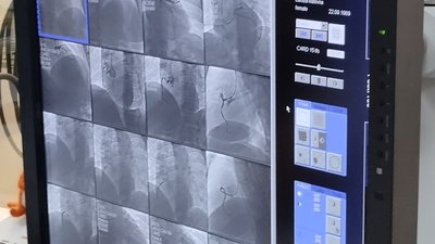 В першій лікарні Житомира почали проводити операції із відновлення кровоплину у судинах серця В першій лікарні Житомира почали проводити операції із відновлення кровоплину у судинах серця