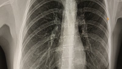 Пересувний флюорограф: у громаді на Волині безплатно обстежують людей