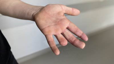 Виробнича травма. Львівські лікарі "пришили" пальці 21-річному хлопцю Виробнича травма. Львівські лікарі "пришили" пальці 21-річному хлопцю