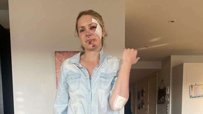 "Нічого не пам'ятаю". Норвезька біатлоністка потрапила у серйозну аварію на велосипеді: фото