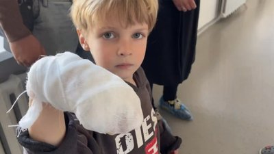 Львівські медики пришили палець трирічному хлопчику, який запхав руку у січкарню Львівські медики пришили палець трирічному хлопчику, який запхав руку у січкарню