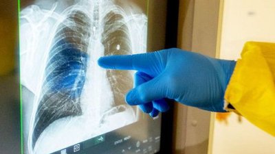 На Івано-Франківщині за добу медики виявили 436 нових випадків COVID-19