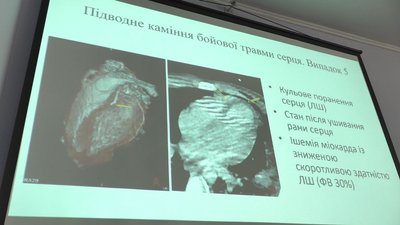 Новий досвід: черкаських медиків навчали воєнній кардіохірургії