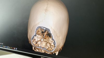 "Уламок від снаряда пройшов крізь голову". У Львові лікують 9-річну дівчинку з Миколаєва