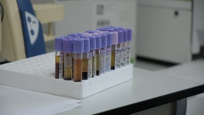 "Потрібно раз на рік проходити обстеження": на Вінниччині на вірусний гепатит В і С хворіють близько 1000 людей