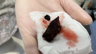 Уламок біля серця. Львівські лікарі врятували пораненого підлітка з Бахмута Уламок біля серця. Львівські лікарі врятували пораненого підлітка з Бахмута