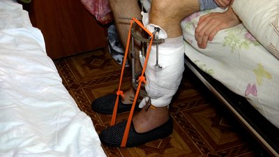 У Житомирській обласній лікарні пролікували майже 300 людей, які постраждали під час бойових дій У Житомирській обласній лікарні пролікували майже 300 людей, які постраждали під час бойових дій