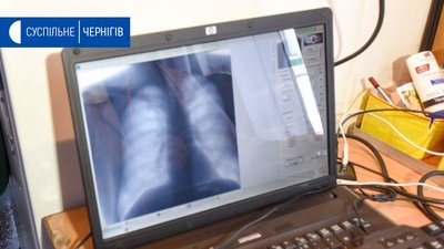 Коронавірус на Чернігівщині: 16 одужали, 5 захворіли, померла людина із супутніми хворобами