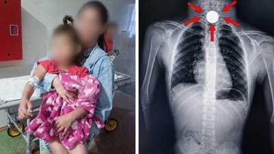 На Закарпатті двоє дітей проковтнули монети: що відомо