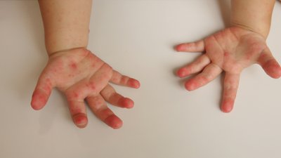 Дитина, яка захворіла на Коксакі на Чернігівщині у Корюківці