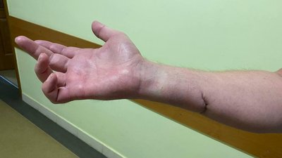 Зможе знову рухати пальцями: у Львові військовому пересадили нерв Зможе знову рухати пальцями: у Львові військовому пересадили нерв