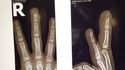 Харків'янка, дитину якої травмували шкільні двері, звинувачує заклад у халатності
