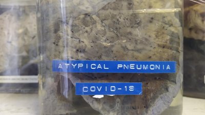 Легені людини із COVID-19 стали експонатом львівського музею