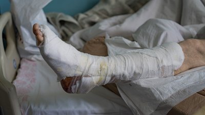 Рятують від ампутацій. На Дніпропетровщині використовують VAC-апарати для лікування військових Рятують від ампутацій. На Дніпропетровщині використовують VAC-апарати для лікування військових