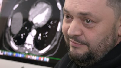 Одна з найскладніших патологій: у черкаському кардіоцентрі пацієнт серцево-судинної хірургії отримав шанс на друге життя Одна з найскладніших патологій: у черкаському кардіоцентрі пацієнт серцево-судинної хірургії отримав шанс на друге життя